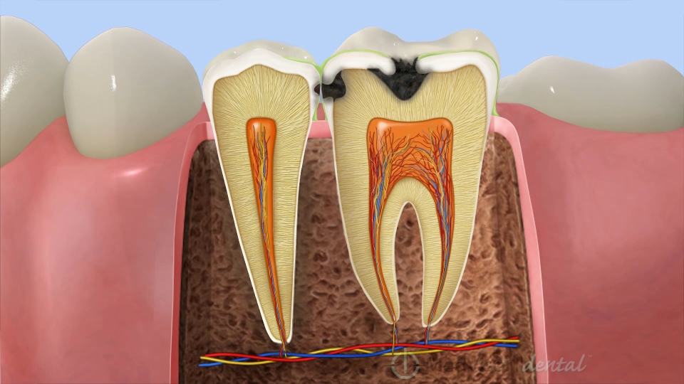 象牙質に進んだむし歯（C2）