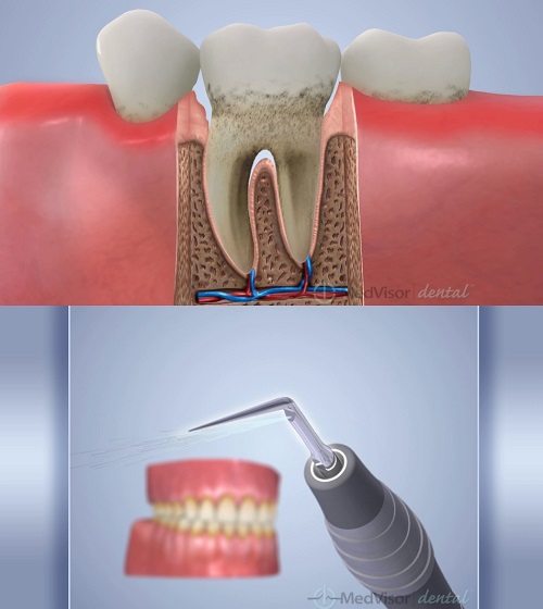 歯肉炎は歯周病の前段階