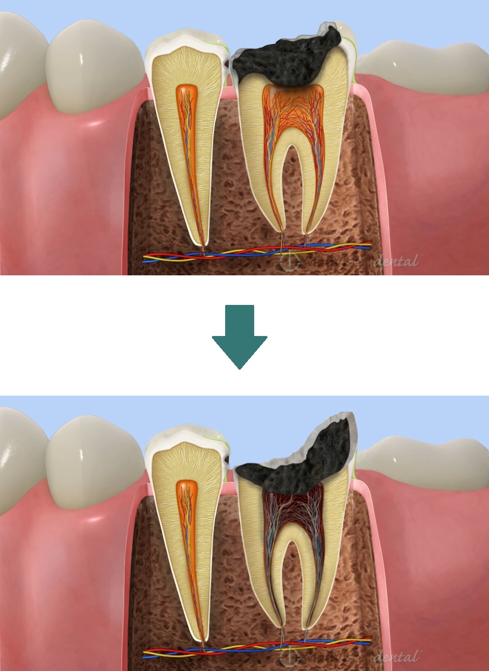 歯髄まで進んだむし歯（C3）